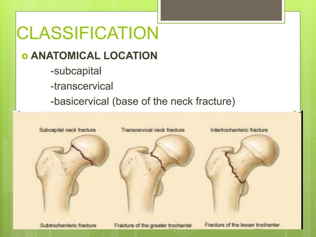 Nof fracture