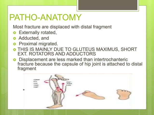 Nof fracture
