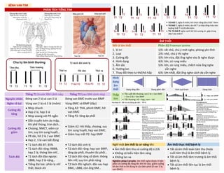 BỆNH VAN TIM
PHÂN TÍCH TIẾNG TIM
• T3 thất T, nghe ở mỏm, khi chức năng tthu thất T kém
• T4 thất T, nghe ở mỏm, do nhĩ T co bóp tống máu vào
buồng thất T có độ dãn kém.
• T3, T4 thất P nghe cạnh bờ trái xương ức, gặp trong
dãn/ dày thất P.
ÂM THỔI
Mô tả âm thổi Phân độ Freeman Levine
1. Vị trí
2. Loại
3. Cường độ
4. Hình dạng
5. Âm sắc
6. Hướng lan
7. Thay đổi theo tư thế/hô hấp
1/6: rất nhỏ, chú ý mới nghe, phòng yên tĩnh
2/6: nhỏ, chú ý thì nghe
3/6: lớn vừa, đặt ống nghe vào là nghe được
4/6: lớn, có rung miêu
5/6: lớn, có rung miêu, chếch nửa ống nghe
avẫn nghe
6/6: lớn nhất, đặt ống nghe cách da vẫn nghe
Hình
dạng
âm
thổi
Tiếng T1 (trước ĐM cảnh nảy) Tiếng T2 (sau ĐM cảnh nảy) Thấp
tim
• Tần suất tổn thương: van 2 lá > Van ĐMC
> Van 3 lá > Van ĐMP
• Tổn thương: nữ – hẹp, nam – hở
Nguyên nhân Đóng van 2 lá và van 3 lá Đóng van ĐMC trước van ĐMP
Nghe rõ tại Vùng van 2 lá và 3 lá (mỏm) Vùng ĐMC và ĐMP (đáy)
Cường độ
tăng
• Nhịp nhanh
• Hẹp 2 lá, hẹp 3 lá
• Nhịp xoang với PR ngắn
• Tăng A2: THA, phình ĐMC, hở
van ĐMC
• Tăng P2: tăng áp phổi
Cường độ
giảm
• Dẫn truyền kém do mập,
khí phế thủng, tràn dịch…
• Choáng, NMCT, viêm cơ
tim, suy tim sung huyết…
• PR dài, hở 2 lá / van ĐMC
• Hẹp 2, 3 lá van bất động
• Giảm A2: HA thấp, choáng, suy
tim sung huyết, hẹp van ĐMC.
• Giảm hay mất P2: hẹp ĐMP
Tách đôi
• T1 tách đôi BT: 85%
• T1 tách đôi rộng: RBBB,
hẹp 2 lá, thông liên nhĩ…
• T1 tách đôi đảo ngược:
LBBB, hẹp 2 lá nặng…
• Tiếng đại bác: phân ly nhĩ
thất, block AV
• T2 tách đôi sinh lý
• T2 tách đôi rộng: hẹp van ĐMP,
tăng áp phổi, thuyên tắc phổi…
• T2 tách đôi rộng cố định: thông
liên nhĩ, suy tim phải nặng
• T2 tách đôi nghịch: dãn sau hẹp
ĐMC, LBBB, còn ống ĐM…
Nghĩ một âm thổi là cơ năng khi: Âm thổi thực thể/bệnh lý
• Âm thổi tâm thu có cường độ ≤ 2/6
• Không có biểu hiện lâm sàng
• Không lan xa
• Tất cả âm thổi toàn tâm thu (hoặc
cuối tâm thu) là âm thổi bệnh lý.
• Tất cả âm thổi tâm trương là âm thổi
bệnh lý.
• Tất cả âm thổi liên tục là âm thổi
bệnh lý.
Nghiệm pháp Carvallo: âm thổi nghe được ở bên
phải có cường độ tăng lên khi hít vào, giảm xuống
khi bn thở ra thì đúng là của bên phải (ổ van 3 lá,
van ĐMC)
DUONG
KIM
NGAN
Dạng tăng dần Dạng giảm dần Hình quả trám Dạng tràn
 