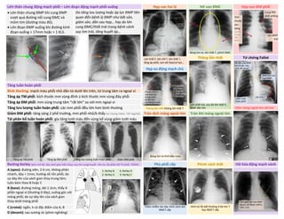 Lớn thân chung động mạch phổi – Lớn đoạn động mạch phổi xuống Hẹp van hai lá Hở van ĐMC Hẹp van ĐM phổi
• Lớn thân chung ĐMP khi cung ĐMP
vượt quá đường nối cung ĐMC và
mỏm tim (đường màu đỏ).
• Lớn đoạn ĐMP xuống khi đường kính
đoạn xuống > 17mm hoặc > 1 KLS.
Do tăng lưu lượng hoặc áp lực ĐMP liên
quan đến bệnh lý ĐMP như bất sản,
giảm sản, dãn sau hẹp… hay do lớn
cung ĐMC/thất trái trong bệnh cảnh
suy tim trái, tăng huyết áp…
Lớn thất P, lớn nhĩ T, lớn thất T,
tăng áp phổi, van vôi hóa/cơ học…
Bóng tim to, lớn thất T, phình ĐMC
Thông liên thất Tứ chứng Fallot
Hẹp eo động mạch chủ
Tăng tuần hoàn phổi
Bình thường: mạch máu phổi nhỏ dần từ dưới lên trên, từ trung tâm ra ngoại vi
Tăng áp TM phổi: kích thước mm vùng đỉnh ≥ kích thước mm vùng đáy phổi
Tăng áp ĐM phổi: mm vùng trung tâm “rất lớn” so với mm ngoại vi
Tăng lưu lượng tuần hoàn phổi: các mm phổi đều lớn hơn bình thường Thông liên nhĩ: không lớn thất T Viêm màng ngoài tim vôi hóa
Giảm ĐM phổi: tăng sáng 2 phế trường, mm phổi nhỏ/k thấy (tứ chứng Fallot, TAP ngphát) Tràn dịch màng ngoài tim Tràn khí màng ngoài tim
Tái phân bố tuần hoàn phổi: gia tăng tưới máu đến vùng kế vùng giảm tưới máu
Đường Kerley (phù mô kẽ, dày vách gian tiểu thùy; suy tim sung huyết –tim to, tái phân bố TH phổi, TDMP) Phù phổi cấp Phình vách thất Vôi hóa động mạch vành
A (apex): đường xiên, 2-6 cm, không phân
nhánh, dày < 1mm, hướng về rốn phổi; do
sự dày lên của vách gian thùy trung tâm;
luôn kèm theo B hoặc C
Thâm nhiễm lan tỏa, hình cánh dơi
NMCT cấp
Hình túi lồi bất thường ở bờ tim T
Sau NMCT cấp
B (base): đường mỏng, dài 1-2cm, thấy ở
phần ngoại vi (thường ở đáy), vuông góc với
màng phổi; do sự dày lên của vách gian
thùy dưới màng phổi
C (croisé): ngắn, k có đặc điểm của A, B
D (devant): sau xương ức (phim nghiêng)
Cung ĐM
phổi phồng
Kích
thước
tim
bthg
(có thể
có lớn
thất
phải)
Lớn ĐMP
trái
Cung ĐMC
Vị trí hẹp
Đoạn lên
ĐMC phồng
thứ phát
Khuyết sườn ở
mặt dưới các
xương sườn
do dãn lớn
các ĐM gian sườn
Lớn thất trái, sau đó lớn thất P,
ĐMP dãn lớn
Độ lớn của ĐMC
tùy thuộc vào
mức độ shunt
ĐMP lõm do
hẹp ĐMP
Lớn thất P
Giảm tuần
hoàn phổi
DUONG
KIM
NGAN
Tăng áp TM phổi Tăng áp ĐM phổi Tăng lưu lượng tuần hoàn phổi Giảm ĐM phổi
Bóng tim to hình bầu rượu
1: Kerley B 3: Kerley D
2: Kerley A 4: Kerley C
Tam giác vôi hóa ĐMV
(quan sát được LMCA,
LAD, LCx)
2
1
3
 
