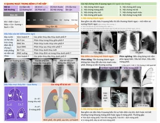 X-QUANG NGỰC TRONG BỆNH LÝ HÔ HẤP Các hội chứng trên X-quang ngực (từ ngoài vào trong)
Mô tả
bất thường
(1) Đậm độ
(2) Đường bờ
(3) Vị trí (3 chiều)
(4) Phân bố
(5) Kích thước
(6) Hội chứng
(7) Cấu trúc
lân cận
1. Hội chứng thành ngực
2. Hội chứng màng phổi
3. Hội chứng nhu mô
4. Hội chứng phế quản
5. Hội chứng phế nang
6. Hội chứng mô kẽ
7. Hội chứng mạch máu
8. Hội chứng trung thất
Đậm độ
Khí < Mỡ < Gan <
Máu < Cơ < Xương <
Barit < Chì
1.Hội chứng thành ngực
Bao gồm các dấu hiệu X-quang biểu thị tổn thương thành ngực – mô mềm và
xương thành ngực (gãy xương, viêm xương…)
• Hình mờ đối với các tổn thương như: viêm, u...
• Hình sáng không đối xứng hai bên thành ngực do bất sản hay teo cơ thành ngực, cắt vú...
• Hình đậm độ vôi do ngấm vôi ở các tổn thương hay các cấu trúc phần mềm thành ngực
Dấu hiệu xóa bờ (Silhouette sign)
Xảy ra khi
có hai cấu
trúc cùng
đậm độ ở
chung 1
mặt phẳng
và nằm sát
nhau
Vòm hoành P Các phân thùy đáy thùy dưới phổi P
Bờ P tim Phân thùy trong thùy giữa phổi P
ĐMC lên Phân thùy trước thùy trên phổi P
Quai ĐMC Phân thùy sau thùy trên phổi T
Bờ T tim Phân thùy dưới thùy lưỡi
ĐMC xuống Phân thùy đỉnh và trong thùy dưới phổi T
Vòm hoành T Các phân thùy đáy thùy dưới phổi P Đặc điểm của bóng mờ thành ngực: Phim nghiêng: Nền rộng bóng mờ nằm
phía ngoại biên. Dấu bờ nhọn. Dấu viền
màng phổi.
Phim thẳng: Tổn thương thành ngực
không làm thay đổi cấu trúc mạch máu
phổi. Không có tổn thương xương. 1: Nhu mô P, 2: MP, 3: Tổn thương, 4: Mỡ ngoài MP
Dấu hiệu mực thủy khí – José Rémy Các vùng dễ bị bỏ sót
A = A’:
trong nhu mô
P ≠ P’:
ở màng phổi
Đỉnh phổi, rốn phổi, sau tim, cơ hoành
2.Hội chứng màng phổi
Bao gồm các dấu hiệu X-quang biểu thị sự hiện diện của khí, dịch hoặc mô bất
thường trong khoang màng phổi hoặc ngay ở màng phổi. Thường gặp:
• Tràn dịch màng phổi; Tràn khí màng phổi; Tràn khí – dịch màng phổi
• U màng phổi, dày và vôi hoá màng phổi
Các bờ thường bị xóa mờ Xóa bờ phải tim
Đông đặc thùy giữa
Xóa bờ trái tim
Đông đặc thùy lưỡi
α nhọn: ngoài phổi α tù: trong phổi
Vôi hóa thành
ngực do giun
tràn
khí
dưới
da
Dị vật: túi ngực
Khí Mỡ Phổi Gan Máu Cơ Xương Kim loại
Lõm ngực Lồi ngực
Tăng đậm độ
DUONG
KIM
NGAN
 