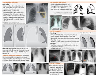 Tràn dịch màng phổi tự do Tràn dịch màng phổi khu trú
Phim thẳng:
• Bóng mờ đều, đồng nhất, không có
khí, ở vùng thấp, xoá góc sườn hoành
(do tiếp xúc và cùng đậm độ với dịch)
• Meniscus sign / đường cong
Damoiseau: cao ở bên, thấp ở trong.
• Lượng dịch thay đổi tương ứng với
bóng mờ thay đổi từ xóa mờ góc sườn
hoành  xóa mờ toàn bộ phế trường.
• TDMP áp lực: đẩy trung thất về phía
đối diện.
Phim nghiêng: đường cong cao ở hai đầu
Lượng dịch: (a): ≈ 200 – 300 ml; (b): ≈ 2 lít; (c): ≈ 5 lít
• Không thay đổi khi thay đổi tư thế.
• Thường kết hợp các tổn thương khác
của MP như dày MP lân cận...
• Hình ảnh có thể tương tự u thành ngực
a, b, c: TDMP khu trú; d: TD rãnh liên thùy bé;
e: TD rãnh liên thùy lớn; f: TD dưới đáy phổi
Tràn khí màng phổi
Phim đứng:
• Vùng tràn khí biểu hiện bằng vùng sáng vô mạch
giữa lá thành và lá tạng, thường ở vùng đỉnh.
• Lá tạng thấy được dưới dạng đường mờ rõ, bao lấy
nhu mô phổi xẹp.
• TKMP áp lực: đẩy lệch trung thất sang bên đối diện.
Phim nằm:
• TKMP lượng ít, khí nằm ở phần cao khó phát hiện.
• Dấu “vòm hoành đôi” vùng sáng vô mạch trên vòm hoành
• Dấu hiệu “khe sâu” góc sườn hoành trở nên rất rõ
Phân độ tràn khí theo BTS:
< 2cm: ít, > 2cm: nhiều
Phim nằm: Bên phổi tràn dịch mờ lan tỏa, các
mạch máu phổi vẫn quan sát được, cần khoảng
200ml để nhìn thấy được, có thể thấy dày rãnh
liên thùy bé
TDMP thể hoành/dưới đáy phổi (< 300-350ml):
vòm hoành cao bất thường, đỉnh nằm ngoài
đường trung đòn, tăng khoảng cách bóng hơi DD
– đáy phổi, không thấy mm phổi sau vòm hoành
Tràn khí – dịch MP
• Vừa có khoảng sáng vô
mạch của TKMP vừa có
bóng mờ của TDMP
• Có thể nhìn thấy mức
khí – dịch phân chia khí
và dịch trong MP
Đường cong Damoiseau
TDMP dạng lớp
Lamellar effusion
TDMP dạng kén
Encyted effusion
TKMP lượng ít TKMP lượng vừa TKMP lượng nhiều
Dấu hiệu
“khe sâu”
DUONG
KIM
NGAN
 
