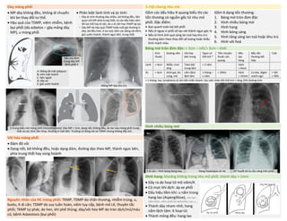 Dày màng phổi 3.Hội chứng nhu mô
• MP dày không đều, không di chuyển
khi bn thay đổi tư thế.
• Hậu quả của TDMP, viêm nhiễm, bệnh
bụi phổi (do asbetos – gây mảng dày
MP), u màng phổi
• Phân biệt lành tính và ác tính:
▫ Dày ác tính thường dày nhiều, bờ không đều, liên
quan với MP phía trung thất, có các dấu hiệu xâm
lấn tại chỗ hay di căn, do u di căn hay TKMP áp lực
▫ Dày MP do hậu quả TDMP hoặc tuổi già thường ít
dày, bờ đều hơn, ít lan toả, kèm các đóng vôi đỉnh,
góc sườn-hoành, thành ngực bên, trung thất.
Gồm các dấu hiệu X-quang biểu thị các
tổn thương có nguồn gốc từ nhu mô
phổi. Đặc điểm:
• Bao quanh toàn bộ bởi phổi
• Nếu ở ngoại vi phổi sẽ tạo với thành ngực góc tù
• Nếu là hình ảnh quá sáng lan toả hay khu trú
thường kèm theo thay đổi số lượng hoặc khẩu
kính mạch máu
Gồm 6 dạng tổn thương:
1. Bóng mờ tròn đơn độc
2. Hình nhiều bóng mờ
3. Hình hang
4. Hình bóng sáng
5. Hình tăng sáng lan toả hoặc khu trú
6. Hình vôi hoá
Bóng mờ tròn đơn độc: < 3cm – nốt/> 3cm – khối
Kích
thước
Đường viền Vôi hóa
bên trong
Tgian x2
thể tích *
Tẩm nhuộm
thuốc cản
quang
Nếu
tạo
hang
Nếu tổn
thương kết
hợp
Tuổi
Lành < 4cm Nhẵn, trơn
láng
Toàn bộ/
trung tâm
> 2 năm Vách
< 4mm
Ác > 4cm Hình gai, đa
cung, mờ
Lấm tấm/
lệch tâm
1 tháng –
1 năm
> 20HU Vách
> 15mm
Co kéo, Rigler
notch sign
> 50t
≈ 50%
< 1 tháng: lao, lymphoma di căn tiến triển nhanh. Qui ước nhân đôi thể tích = tăng 25% đường kính
Hình nhiều bóng mờ
Vôi hóa màng phổi
• Đậm độ vôi
• Dạng nốt, bờ không đều, hoặc dạng đám, đường dọc theo MP, thành ngực bên,
phía trung thất hay vùng hoành
Hình hang: khoảng không trong nhu mô phổi, thành dày > 1mm
• Gây ra do hoại tử mô viêm/K
• Có mực khí dịch: áp xe phổi
• Dấu hiệu liềm khí: u nấm trong
hang lao (Aspergillose), các loại
nấm khác, viêm phổi do klebsiella, lao, u...
• Thành dày nham nhở, hang
nằm lệch tâm: K hoại tử.
• Thành mỏng đều: hang lao
Nguyên nhân của HC màng phổi: TKMP, TDMP do chấn thương, nhiễm trùng, u,
bướu, K di căn; TDMP do suy tuần hoàn, viêm tụy cấp, bệnh mô LK, thuyên tắc
phổi; TKMP tự phát, do hen, khí phế thủng; dày/vôi hóa MP do tràn dịch/mủ/máu
cũ, bệnh Asbestosis (bụi phổi)
Dấu mủ đỉnh
trong dày MP
đỉnh phổi P
A: Mảng bề mặt (plaque)
B: trên mặt hoành
C: bên ngoài
D: dãy xơ
E: góc sườn hoành
Mảng MP dày khu trú
U trung biểu mô màng phổi (mesothelioma): Dày MP > 1cm, dạng nốt, không đều, ăn lan vào màng phổi trung
thất và các rãnh liên thùy, thường ở một bên. Thường có đóng vôi và TDMP nhưng không đẩy tim.
K di căn – hình bong bóng bay Nang Hydatique rải rác NT huyết do tụ cầu vàng trên phổi
DUONG
KIM
NGAN
 