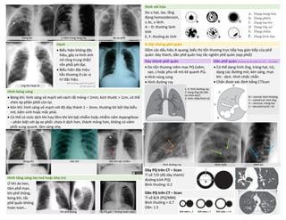 Hình vôi hóa
Do u hạt, lao, lắng
đọng hemosiderosin,
u ác, u lành.
A – D: thường lành
tính
E, F: thường ác tính
Hạch 4.Hội chứng phế quản
• Biểu hiện không đặc
hiệu, gây ra hình ảnh
nở rông trung thất/
rốn phổi phì đại.
• Biểu hiện đặc hiệu:
tổn thương ở các vị
trí đặc hiệu.
Mất đường cạnh khí quản P
do lớn hạch 4R
Gồm các dấu hiệu X-quang, biểu thị tổn thương trực tiếp hay gián tiếp của phế
quản: dày thành, dãn phế quản hay tắc nghẽn phế quản (xẹp phổi)
Dày thành phế quản Dãn phế quản (thường do lao phổi cũ, HTL – ho mạn)
• Do tổn thương niêm mạc PQ (viêm,
sẹo..) hoặc phù nề mô kẽ quanh PQ.
• Hình nòng súng
• Hình đường ray
• Có thể dạng hình ống, tràng hạt, túi,
dạng các đường mờ, kén sáng, mực
khí - dịch. Hình chiếc nhẫn
• Chẩn đoán xác định bằng CTScan
Hình bóng sáng
• Bóng khí: hình sáng vô mạch với vách rất mỏng < 1mm, kích thước > 1cm, có thể
chèn ép phần phổi còn lại.
• Kén khí: hình sáng vô mạch với độ dày thành 1 – 3mm, thường lót bởi lớp biểu
mô, bẩm sinh hoặc mắc phải.
• Có thể có mức dịch khí hay liềm khí khi bội nhiễm hoặc nhiễm nấm Aspergillose
– phân biệt với áp xe phổi: chứa ít dịch hơn, thành mỏng hơn, không có viêm
phổi xung quanh, lâm sàng nhẹ.
Dày PQ trên CT – Scan:
Tỉ số T/D (độ dày thành/
đường kính PQ)
Bình thường: 0.2
Hình tăng sáng lan toả hoặc khu trú
Ứ khí do hen,
tâm phế mạn,
khí phế thũng,
bóng khí, tắc
phế quản không
hoàn toàn…
Dãn PQ trên CT – Scan:
Tỉ số B/A (PQ/MM)
Bình thường ≈ 0.7
Dãn: 1.5
Hang lao U nấm trong hang lao Áp xe phổi
Bóng khí Kén khí Kén khí bội nhiễm
Hình đường ray Hình nhẫn Hình túi
Khí phế thủng Tắc PQ gốc T không hoàn toàn
Ung thư hoại tử
1, 4: Hình đường ray.
2: Dạng ống (do dãn
và chứa dịch)
3: Hình nhẫn/hình túi
N – normal: bình thường
C – cylindrical: hình ống
V – varicose: tràng hạt
S – saccular/cyctic: túi
DUONG
KIM
NGAN
 