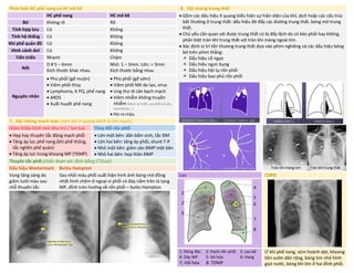 Phân biệt HC phế nang và HC mô kẽ 8. Hội chứng trung thất
HC phế nang HC mô kẽ • Gồm các dấu hiệu X quang biểu hiện sự hiện diện của khí, dịch hoặc các cấu trúc
bất thường ở trung thất: dấu hiệu đè đẩy các đường trung thất, bóng mờ trung
thất.
• Chủ yếu cần quan sát được trung thất có bị đẩy lệch do có kéo phổi hay không,
phân biệt tràn khí trung thất với tràn khí màng ngoài tim.
• Xác định vị trí tổn thương trung thất dựa vào phim nghiêng và các dấu hiệu bóng
bờ trên phim thẳng:
 Dấu hiệu cổ ngực
 Dấu hiệu ngực bụng
 Dấu hiệu hội tụ rốn phổi
 Dấu hiệu bao phủ rốn phổi
Bờ Không rõ Rõ
Tính hợp lưu Có Không
Tính hệ thống Có Không
Khí phế quản đồ Có Không
Hình cánh dơi Có Không
Tiến triển Nhanh Chậm
Nốt
D # 5 – 6mm
Kích thước khác nhau
Nhỏ: 1 – 3mm. Lớn: > 3mm
Kích thước bằng nhau
Nguyên nhân
• Phù phổi (gđ muộn)
• Viêm phổi thùy
• Lymphoma, K PQ, phế nang
• ARDS
• Xuất huyết phế nang
• Phù phổi (gđ sớm)
• Viêm phổi MK do lao, virus
• Ung thư di căn bạch mạch
• Viêm nhiễm không truyền
nhiễm (bệnh tự miễn, xơ phổi vô căn,
sarcoidosis…)
• Ho ra máu
7. Hội chứng mạch máu (xem bài X-quang bệnh lý tim mạch)
Giảm khẩu kính mm khu trú / lan toả Thay đổi rốn phổi
• Hẹp hay thuyên tắc động mạch phổi
• Tăng áp lực phế nang (khí phế thũng,
tắc nghẽn phế quản)
• Tăng áp lực trong khoang MP (TKMP)
• Lớn một bên: dãn bẩm sinh, tắc ĐM
• Lớn hai bên: tăng áp phổi, shunt T-P
• Nhỏ một bên: giảm sản ĐMP một bên
• Nhỏ hai bên: hẹp thân ĐMP
Thuyên tắc phổi (chẩn đoán xác định bằng CTScan)
Dấu hiệu Westermark Bướu Hampton
Vùng tăng sáng do
giảm tưới máu sau
chỗ thuyên tắc.
Sau nhồi máu phổi xuất hiện hình ảnh bóng mờ đồng
nhất hình chêm ở ngoại vi phổi có đáy nằm trên lá tạng
MP, đỉnh tròn hướng về rốn phổi – bướu Hampton.
Lao COPD
1: Đông đặc 2: Hạch rốn phổi 3: Lao kê
4: Dày MP 5: Xơ hóa 6: Hang
7: Vôi hóa 8: TDMP
Ứ khí phế nang, vòm hoành dẹt, khoang
liên sườn dãn rộng, bóng tim nhỏ hình
giọt nước, bóng khí lớn ở hai đỉnh phổi.
Tràn khí màng tim Tràn khí trung thất
4
5
6
a
7
8
1
2
3
DUONG
KIM
NGAN
 