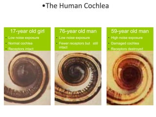 17-year old girl
• Low noise exposure
• Normal cochlea
• Receptors intact
76-year old man
• Low noise exposure
• Fewer receptors but still
intact
59-year old man
• High noise exposure
• Damaged cochlea
• Receptors destroyed
•The Human Cochlea
 
