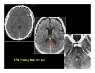Tổn thương trục lan toả
 