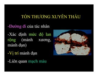 -Đường đi của tác nhân
-Xác định mức độ lan
rộng (mảnh xương,
mảnh đạn)
-Vị trí mảnh đạn
-Liên quan mạch máu
TỔN THƯƠNG XUYÊN THẤU
 