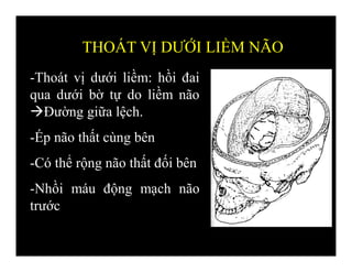 -Thoát vị dưới liềm: hồi đai
qua dưới bờ tự do liềm não
Đường giữa lệch.
-Ép não thất cùng bên
-Có thể rộng não thất đối bên
-Nhồi máu động mạch não
trước
THOÁT VỊ DƯỚI LIỀM NÃO
 
