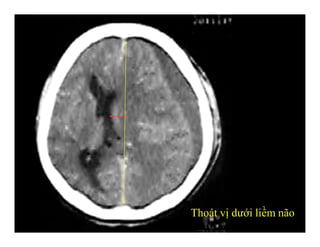 Thoát vị dưới liềm não
 