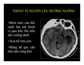 -Mỏm móc của hồi
cạnh hải mã thoát
vị qua khe lều tiểu
não xuống dưới
+Xoá bể trên yên
+Rộng bể góc cầu
tiểu não cùng bên
THOÁT VỊ XUYÊN LỀU HƯỚNG XUỐNG
 