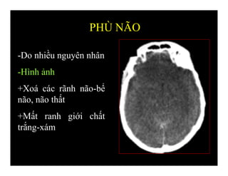 -Do nhiều nguyên nhân
-Hình ảnh
+Xoá các rãnh não-bể
não, não thất
+Mất ranh giới chất
trắng-xám
PHÙ NÃO
 