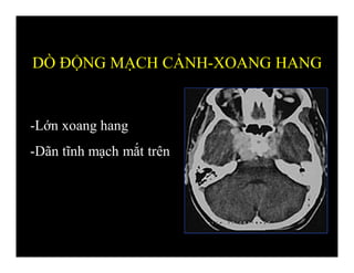 -Lớn xoang hang
-Dãn tĩnh mạch mắt trên
DÒ ĐỘNG MẠCH CẢNH-XOANG HANG
 