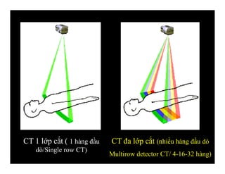 CT 1 lớp cắt ( 1 hàng đầu
dò/Single row CT)
CT đa lớp cắt (nhiều hàng đầu dò
Multirow detector CT/ 4-16-32 hàng)
 