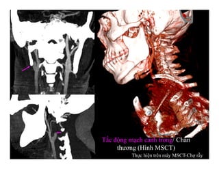 Tắc động mạch cảnh trong/ Chấn
thương (Hình MSCT)
Thực hiện trên máy MSCT-Chợ rẫy
 