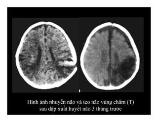 Hình ảnh nhuyễn não và teo não vùng chẩm (T)
sau dập xuất huyết não 3 tháng trước
 