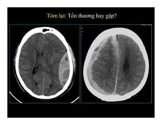 Tóm lại: Tổn thương hay gặp?
 