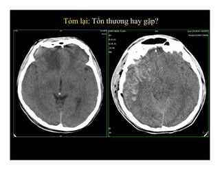 Tóm lại: Tổn thương hay gặp?
 