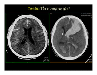 Tóm lại: Tổn thương hay gặp?
 