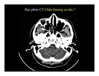 Đọc phim CT Chấn thương sọ não ?
 
