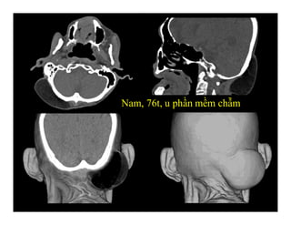 Nam, 76t, u phần mềm chẫm
 