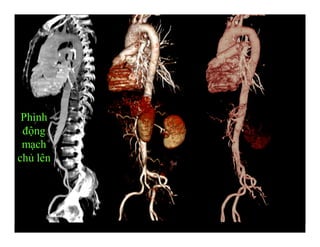 Phình
động
mạch
chủ lên
 