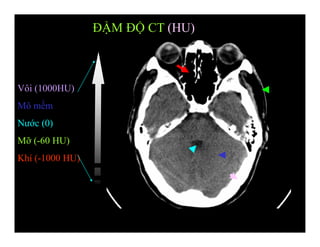 ĐẬM ĐỘ CT (HU)
Vôi (1000HU)
Mô mềm
Nước (0)
Mỡ (-60 HU)
Khí (-1000 HU)
 
