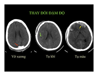 THAY ĐỔI ĐẬM ĐỘ
Vỡ xương Tụ khí Tụ máu
 