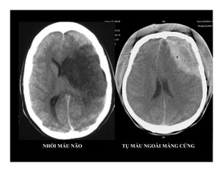 NHỒI MÁU NÃO TỤ MÁU NGOÀI MÀNG CỨNG
 