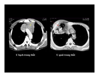 U hạch trung thất U quái trung thất
 