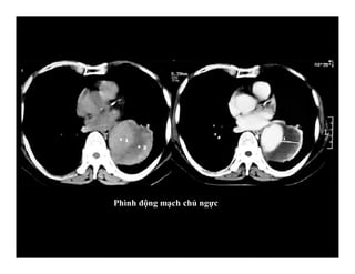 Phình động mạch chủ ngực
 