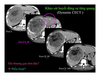 PreCE
Post CE 30’’
Post CE 90’’
Post CE 180’’
Khảo sát huyết động sự tăng quang
(Dynamic CECT )
Tổn thương gan đơn độc?
 Phẫu thuật?
 