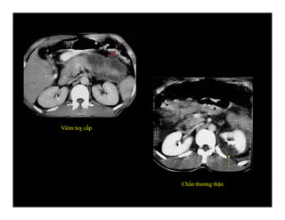 Viêm tuỵ cấp
Chấn thương thận
 