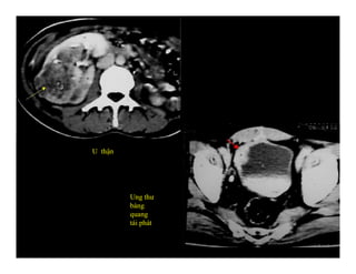 U thận
Ung thư
bàng
quang
tái phát
 