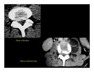 Thoát vị đĩa đệm
Aùp-xe cạnh cột sống
 