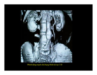 Phình động mạch chủ bụng-Hình tái tạo 3 D
 