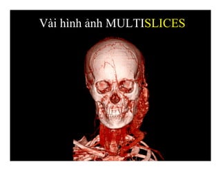Vài hình ảnh MULTISLICES
 