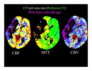 CBF MTT CBV
CT tưới máu não (Perfusion CT)
Phát hiện sớm đột qụi
 