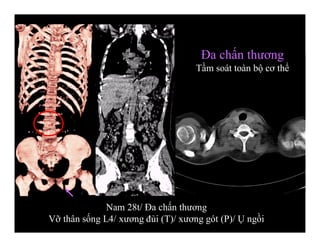 Đa chấn thương
Tầm soát toàn bộ cơ thể
Nam 28t/ Đa chấn thương
Vỡ thân sống L4/ xương đùi (T)/ xương gót (P)/ Ụ ngồi
 