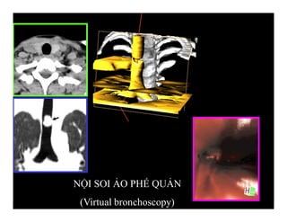 NỘI SOI ẢO PHẾ QUẢN
(Virtual bronchoscopy)
 