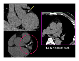 Đóng vôi mạch vành
 