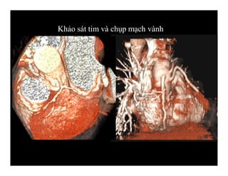 Khảo sát tim và chụp mạch vành
 