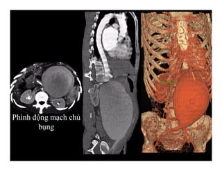 Phình động mạch chủ
bụng
 