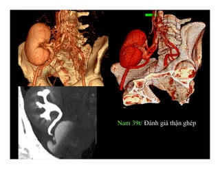 Nam 39t/ Đánh giá thận ghép
Thận ghép
 