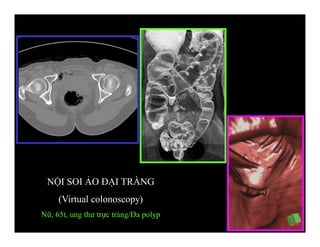 NỘI SOI ẢO ĐẠI TRÀNG
(Virtual colonoscopy)
Nữ, 65t, ung thư trực tràng/Đa polyp
 