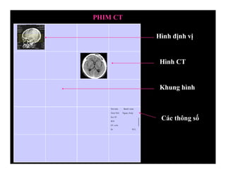 Hoï-teân Beänh vieän
Nam-Nöõ Ngaøy chuïp
Soá ID
ROI
kV, mAs
S# W/L
Hình định vị
Hình CT
Khung hình
PHIM CT
Các thông số
 