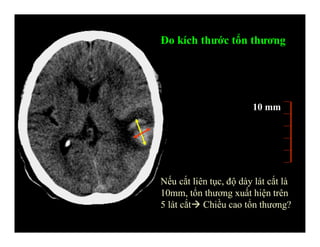 Đo kích thước tổn thương
10 mm
Nếu cắt liên tục, độ dày lát cắt là
10mm, tổn thương xuất hiện trên
5 lát cắt Chiều cao tổn thương?
 