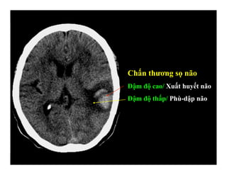 Chấn thương sọ não
Đậm độ cao/ Xuất huyết não
Đậm độ thấp/ Phù-dập não
 