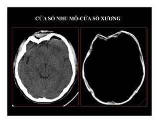 CỬA SỔ NHU MÔ-CỬA SỔ XƯƠNG
 
