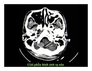 Giải phẫu hình ảnh sọ não
 